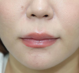 20代女性の人中短縮(リップリフト) Before 症例写真
