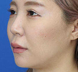 20代女性の人中短縮(リップリフト) Before 症例写真