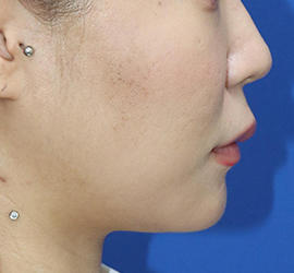 20代女性の人中短縮(リップリフト) Before 症例写真