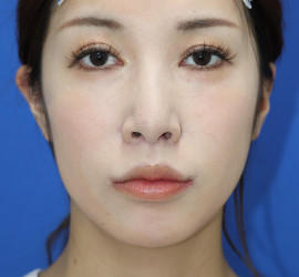 20代女性の人中短縮（リップリフト） After 症例写真