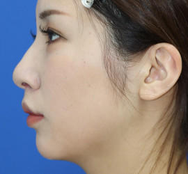 20代女性の人中短縮（リップリフト） After 症例写真