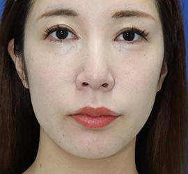 20代女性の人中短縮（リップリフト） Before 症例写真