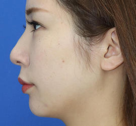 20代女性の人中短縮（リップリフト） Before 症例写真