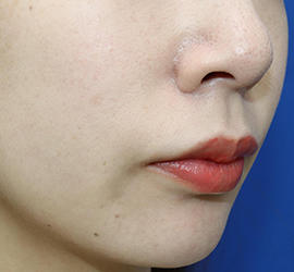 20代女性の人中短縮（リップリフト） Before 症例写真