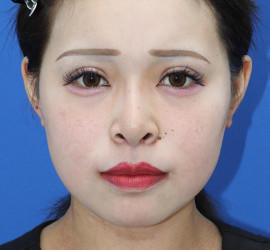 20代女性の唇・口元の整形 After 症例写真