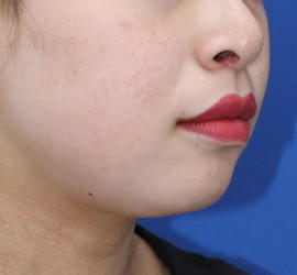 20代女性の人中短縮(リップリフト) After 症例写真