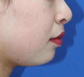 20代女性の人中短縮(リップリフト) After 症例写真