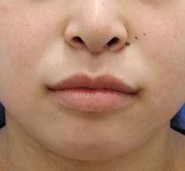 20代女性の人中短縮(リップリフト) After 症例写真