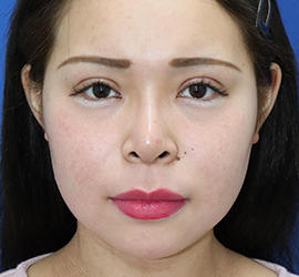 20代女性の唇・口元の整形 Before 症例写真