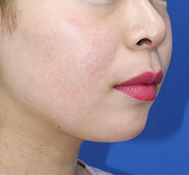 20代女性の人中短縮(リップリフト) Before 症例写真
