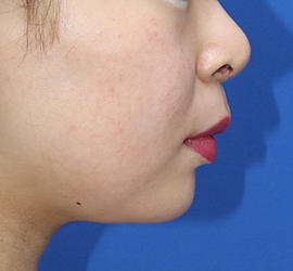 20代女性の人中短縮(リップリフト) Before 症例写真