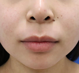 20代女性の人中短縮(リップリフト) Before 症例写真