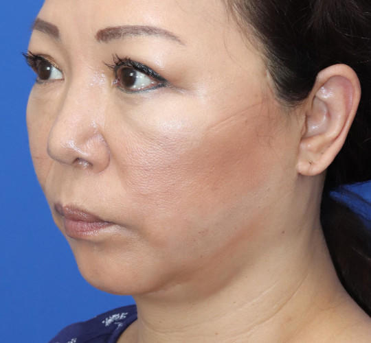 50代女性のチークリフト・フェイスリフト After 症例写真