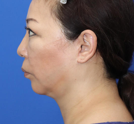 50代女性のチークリフト・フェイスリフト After 症例写真