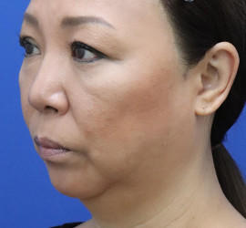 50代女性のチークリフト・フェイスリフト Before 症例写真