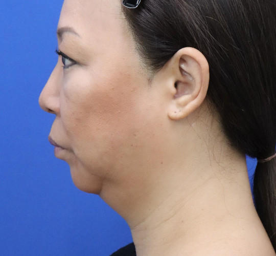 50代女性のチークリフト・フェイスリフト Before 症例写真