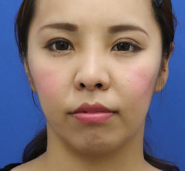 30代女性の人中短縮(リップリフト) After 症例写真