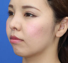 30代女性の唇・口元の整形 After 症例写真