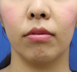 30代女性の人中短縮(リップリフト) After 症例写真
