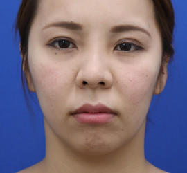 30代女性の人中短縮(リップリフト) Before 症例写真