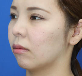 30代女性の唇・口元の整形 Before 症例写真