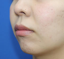 30代女性の人中短縮(リップリフト) Before 症例写真