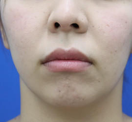 30代女性の人中短縮(リップリフト) Before 症例写真