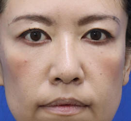 40代女性の唇・口元の整形 After 症例写真