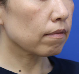 40代女性の人中短縮（リップリフト） After 症例写真