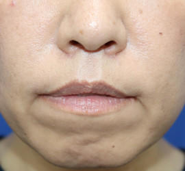 40代女性の人中短縮（リップリフト） After 症例写真