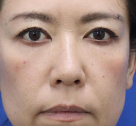 40代女性の唇・口元の整形 Before 症例写真