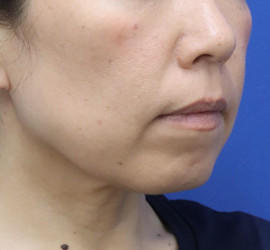 40代女性の人中短縮（リップリフト） Before 症例写真