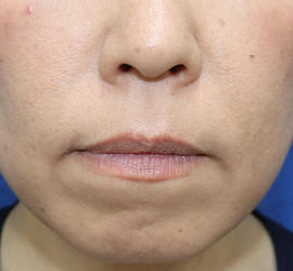 40代女性の人中短縮（リップリフト） Before 症例写真