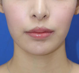 20代女性の唇・口元の整形 After 症例写真