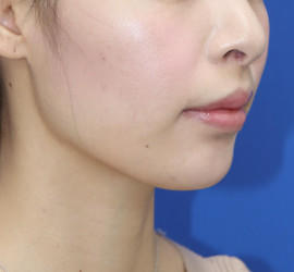 20代女性の人中短縮（リップリフト） After 症例写真