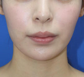 20代女性の唇・口元の整形 Before 症例写真
