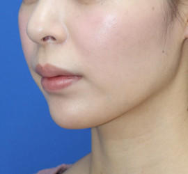 20代女性の人中短縮（リップリフト） Before 症例写真