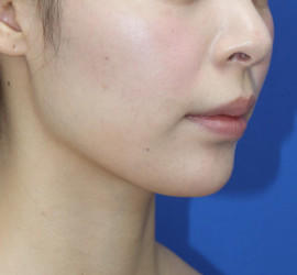 20代女性の人中短縮（リップリフト） Before 症例写真