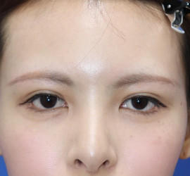 20代女性のタレ目・でか目形成 After 症例写真