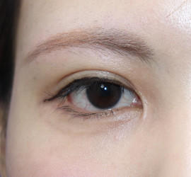 20代女性の二重整形・目元の整形 After 症例写真