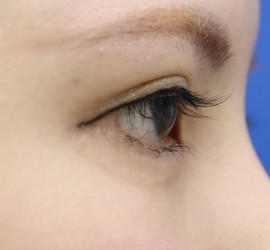 20代女性のタレ目・でか目形成 After 症例写真