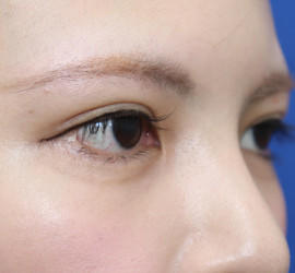 20代女性のタレ目・でか目形成 After 症例写真
