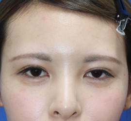 20代女性のタレ目・でか目形成 Before 症例写真