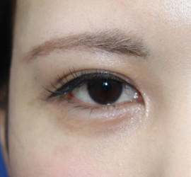 20代女性の二重整形・目元の整形 Before 症例写真