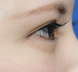 20代女性のタレ目・でか目形成 Before 症例写真