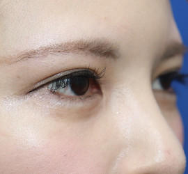 20代女性のタレ目・でか目形成 Before 症例写真