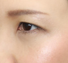 30代女性の目の下の脱脂  After 症例写真