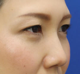 30代女性の目の下の脱脂  After 症例写真