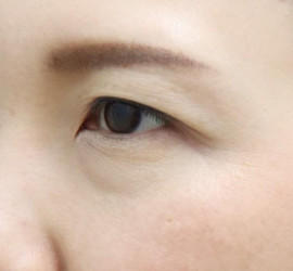 30代女性の目の下の脱脂  Before 症例写真