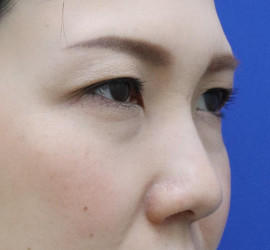 30代女性の目の下の脱脂  Before 症例写真